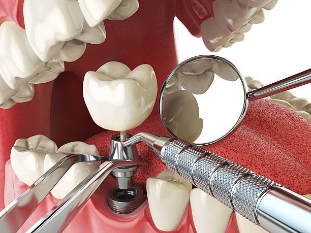 Best Broken or Cracked Tooth Emergency Dentist in Woodland Hills, UT